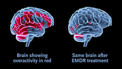 EMDR Tekniği İle Panik Atak Terapisi